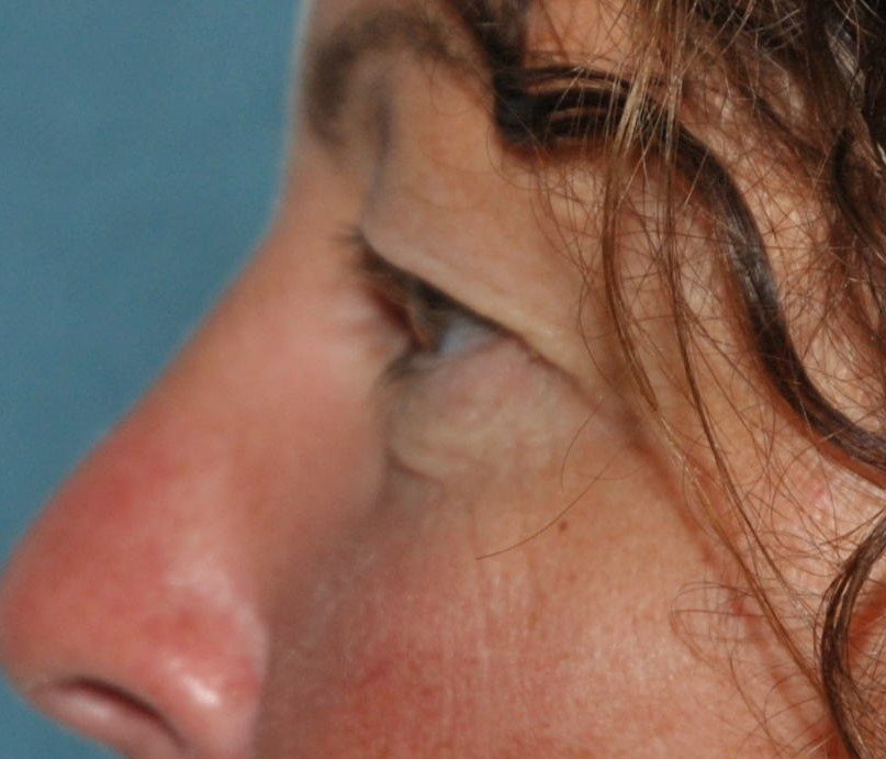 ooglidcorrectie voor 2 profiel